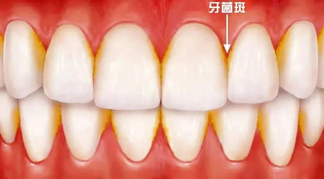 牙齦炎和牙周炎只有一字之差，區別竟然這麼大！