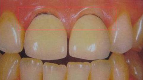 爲什麼牙醫叫您做二氧化鋯全瓷牙？ 看完你就知道了