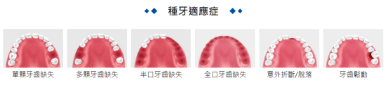 澳門種牙 透明公開不亂收費 | 澳門人牙醫推介，實力保證